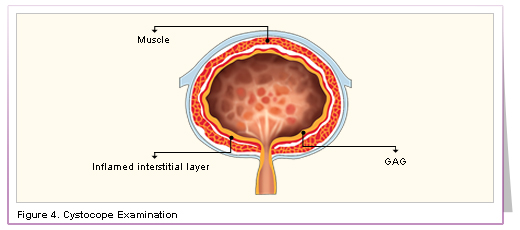 GAG layer in the bladder